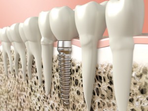 Dental implant