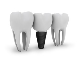 Our Stratford, CT area patients know that dental implants provide a better treatment option for missing teeth than dentures.