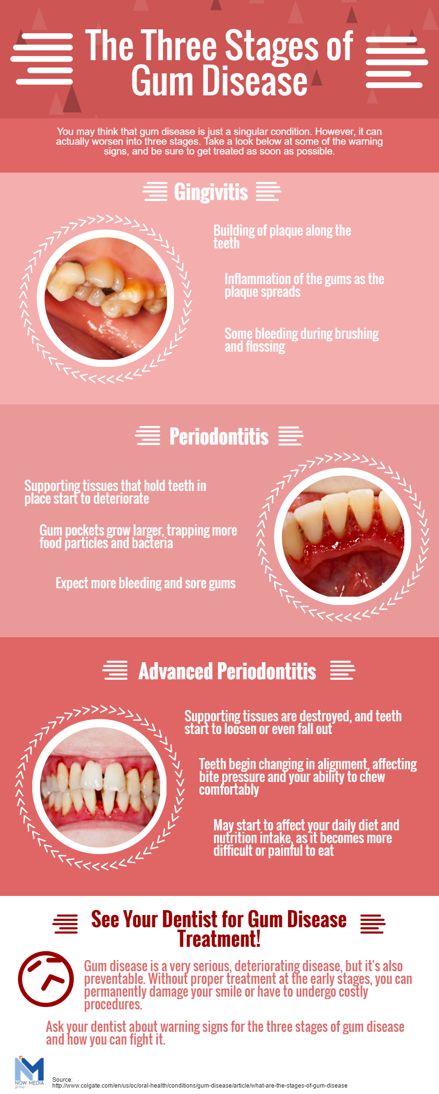 The three stages of gum disease